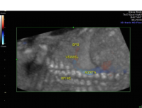 Bronchopulmonary sequestration 3D glass body doppler